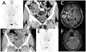 Disease presentation and response to treatment. (A) Initial PET shows FDG-avid bone metastases in left acetabulum (arrows) and right pubic ramus (arrowhead). (B) Follow-up CT after 9 months on crizotinib shows new enhancing right thigh mass (curved arrow), indicating disease progression. (C) Brain MRI during hospitalization for arm weakness shows large right temporal mass (dashed arrow), later confirmed as metastatic IMT with TPM3::ALK fusion. (D) CT after SBRT to right thigh mass arising from superior pubic ramus shows significant tumor shrinkage. (E) PET after switching to lorlatinib with ICIs shows resolution of bone metastases. (F) Brain MRI shows post-surgical changes without recurrence.