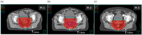 The three patients, (a) Patient 1, (b) Patient 2, and (c) Patient 3, shown at the axial isocentric plane. Distances from the posterior surface to the PTV are shown.