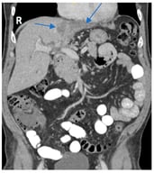 Coronal view of the CT of the abdomen and pelvis with contrast showed irregular enhancement in the right upper quadrant, suggestive of an intrahepatic cholangiocarcinoma with involvement of the left hepatic lobe (blue arrows). The primary tumor metastasized to the umbilicus and presented as an umbilical mass found on examination of the patient.