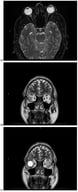 (a) Magnetic Resonance Imaging (MRI) of the brain and orbits fat-saturated T2-weighted axial image showing mild right greater than left T2 hyperintense signal in the periphery of the optic nerves in the anterior intraorbital region, consistent with optic neuritis. A: anterior, R: right; (b) MRI of the brain and orbits coronal T2-weighted image showing right sided optic neuritis. S: superior, R: right; (c) MRI of the brain and orbits coronal T2-weighted image showing left sided optic neuritis. S: superior, R: right.