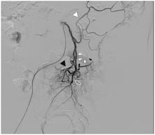 Arteriography of a normal inferior mesenteric artery: from the vessel arise the left colic artery (white arrowhead), the main sigmoid artery (white arrows) which continues into the marginal artery of Drummond (black arrow); the terminal branch is the superior rectal artery (white contour arrow) from which typically arise an accessory sigmoid branch (black arrowhead).