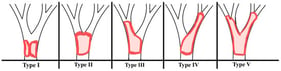 Schematic diagram of the Bismuth–Corlette classification of hilar cholangiocarcinoma (HCCA). Type I: limited to the common hepatic duct, below the level of the confluence of the right and left hepatic duct; Type II: involves the confluence of the right and left hepatic ducts; Type III: type II and extends to involve the origin of the right hepatic duct; Type IV: type II and extends to involve the origin of the left hepatic duct; Type V: extending to and involving the origins of both right and left hepatic ducts (segmental ducts) and/or multifocal involvement.