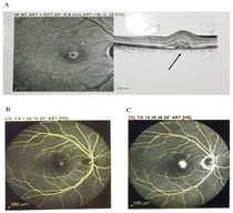 The OCT and fluorescein angiogram of the right eye of the studied subject. (A) OCT of the right eye at presentation showed fibrovascular pigment epithelial detachment with subretinal fluid and hyperreflective material nasal to fovea with outer retinal layer damage in the right eye (central retinal thickness, CRT 327 μm), black arrow indicates the CNV (B) The fluorescein angiogram showing early phase, an active lesion adjacent to fovea in the right eye. (C) Increase in size and intensity in the late phase indicative of active leakage.