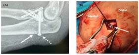 Lateral elbow radiograph demonstrating coronoid fixation with a 3.5 mm screw (dashed arrow) and the 2 mm drill tunnel used to pass the non-absorbable suture securing the anterior capsule (solid arrow, (A)). The screw was used as post to secure the suture and capsule (B).