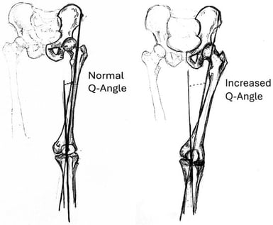Normal quadriceps angle (Q-angle) (left). Increased Q-angle with exaggerated articulation between lateral condyles of femur and patella during weight bearing (right).