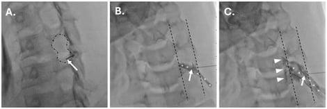 Representative images during a fluoroscopic cervical transforaminal epidural steroid injection. On the foraminal oblique projection (A), the needle (arrow) is positioned in the posteroinferior aspect of the foramen (outlined by dashed line). On the anteroposterior projection during injection of iodinated contrast (B,C), the needle is positioned just across the articular pillars (bracketed by dashes), and there is perineural flow (asterisks) and subsequently transforaminal epidural flow (arrowheads in C) of contrast without evidence of vascular uptake.