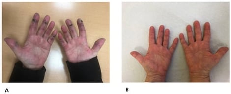 Clinical appearance of hyperkeratotic hands before treatment (A) and after treatment (B).