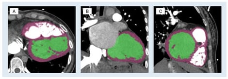 Segmentation process of modeling the left ventricle. The blood pools of the left ventricle and the myocardium are shown in green and purple, respectively. (A) Axial view—a short-axis slice through the left ventricle (classic round/oval LV cavity). (B) Coronal view—a long-axis view showing the LV from anterior to posterior. (C) Sagittal view—the orthogonal long-axis view, slicing left–right through the LV.
