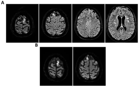 MRI of patient 1 group 1. A 74-year-old woman with a history of atrial fibrillation, ischemic heart disease, anxiety-depressive syndrome, and hypertension was found at home in a stuporous state. She had experienced asthenia and fever in the preceding days and had initiated ciprofloxacin treatment. On arrival, laboratory exams showed leukocytosis (11,930/mm3, 90.4% neutrophils), elevated INR (1.92), and markedly increased inflammatory markers. Arterial blood gas revealed hypoxemia (pO2 55 mmHg), requiring mechanical ventilation with 35% FiO2. Brain CT was unremarkable, showing no acute lesions or signs of raised intracranial pressure. Chest CT revealed bilateral posterior-basal consolidations with air bronchograms (more severe on the left), a smaller consolidation in the left upper lobe, and bilateral pleural effusions, consistent with bronchopneumonia. A lumbar puncture was initially contraindicated due to coagulopathy. Due to worsening neurological status (GCS 6), the patient was transferred to the ICU, intubated, and underwent lumbar puncture. On day 2, TCCD showed PI values of 0.62 (right) and 0.71 (left), with no signs suggestive of intracranial hypertension. (A) 3D axial FLAIR sequence shows multiple bilateral hyperintense areas, without mass effect. (B) Some of these present diffusion restriction in axial DWI sequence with the largest located in the left middle and superior frontal gyrus. There is also a subtle pachymeningeal enhancement in the bilateral fronto-temporal region. Supratentorial and infratentorial ventricular system is normal in size and configuration, with no midline shift or hydrocephalus.