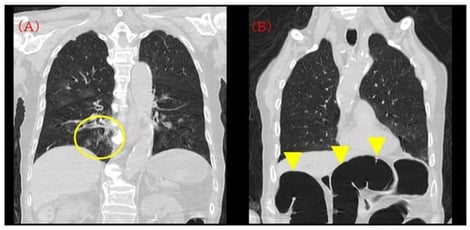 Initial computed tomography (CT) on admission. (A) Chest CT demonstrating mild bronchopneumonia predominantly in the right lower lobe without extensive consolidation or pleural effusion (yellow circle). (B) The same CT series incidentally showing a moderately distended transverse colon with intraluminal gas (yellow arrowhead). This finding was visible on the admission CT but was not pursued with dedicated abdominal evaluation at that time and was later revisited during case review.