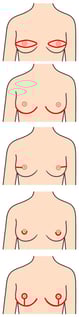 Mastectomy incision types (from top to bottom): ellipse, inframammary fold, lateral, periareolar, Wise pattern.