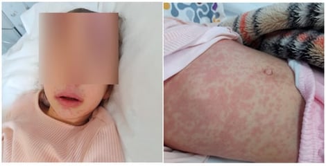 Mucocutaneous manifestations of MIS-C.