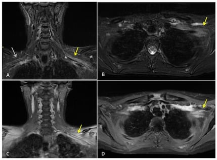MRI brachial plexus: This is a figure. Images (A,B) are coronal and axial T2 STIR images that demonstrate thickening and increased T2 signal of the brachial plexus on the left (yellow arrows). Normal size and signal of the brachial plexus on the right for comparison (white arrow). Images (C,D) are coronal and axial T1 fat-saturated post-contrast images, which demonstrate abnormal hyperenhancement of the thickened brachial plexus on the left side (yellow arrows). Findings are consistent with left brachial plexitis.