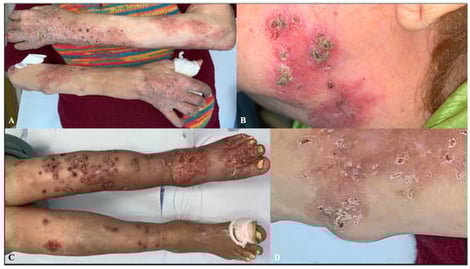 Clinical presentation. Multiple erythematous and scaly plaques, predominantly located on the extremities (A,C) and face (B). One of the lesions evolved into subcutaneous nodules, which was biopsied (D).