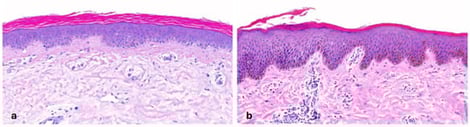 Ichthyosis vulgaris (FLG-nEDD). (a): Orthohyperkeratosis, lamellar type, absence of stratum granulosum and mild acanthosis. Pattern 1 (ID 8, HE, original magnification ×40). (b): Orthohyperkeratosis, compact type, absence of stratum granulosum and acanthosis. Note focal parakeratosis and formation of a stratum granulosum and some spongiosis associated with an inflammatory infiltrate. Pattern 1 (ID 5, HE, original magnification ×40).