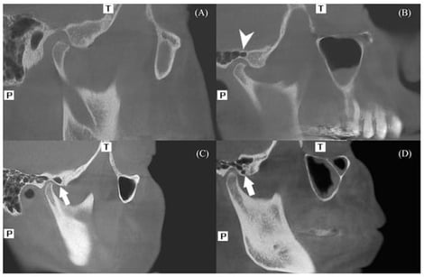(A) Articular eminence and glenoid fossa without pneumatization. (B) Pneumatized glenoid fossa. (C) Unilocular-type pneumatized articular eminence. (D) Multilocular-type pneumatized articular eminence. (T: Top (Superior), P: Posterior).