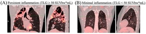Representative PET/CT images of participants who successfully completed a 6-month drug-sensitive anti-TB treatment, showing the lung in coronal view (left) and lateral view (right). (A) Participant with extensive persistent lung inflammation (TLG ≥ 50 SUVbw*mL) and (B) Participant with minimal lung inflammation (TLG < 50 SUVbw*mL).