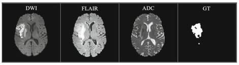 An example of the ISLES 2022 dataset shows the DWI, FLAIR, ADC, and the mask.