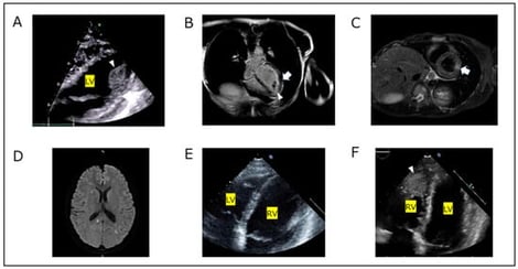 Sequential Imaging During Clinical Course. (A). Echocardiography (four-chamber view, systolic phase): Left ventricular thrombus (Arrowhead) detected during the initial presentation. (B). Cardiac MRI (delayed enhancement): Arrow indicates endocardial thickening; arrowhead indicates intraventricular thrombus. (C). Cardiac MRI (T2-weighted with gadolinium contrast): Arrow shows delayed enhancement in the left ventricular wall, indicating myocardial damage due to myocarditis. (D). Brain MRI (Diffusion-weighted imaging): Multiple cerebral infarctions in the corpus callosum (E). Echocardiography (four-chamber view): Resolution of the left ventricular thrombus observed 11 months after the initial recurrence. (F). Echocardiography (four-chamber view): Right ventricular thrombus at recurrence (2.2 × 2.8 cm). Arrow shows intraventricular thrombosis. Images were obtained at different time points and are not intended for direct slice-by-slice comparison. LV, left ventricular; RV, right ventricular.