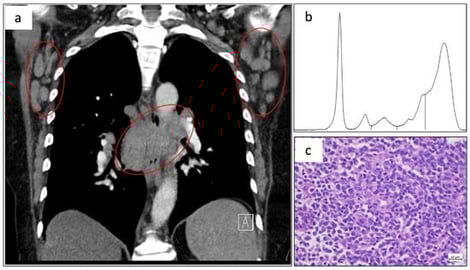 (a) Computed tomography scan showing mediastinal mass and axillary lymphadenopathy (red circles). (b) Serum protein electrophoresis showing broad γ-region elevation favoring polyclonal hypergammaglobulinemia. (c) Representative hematoxylin and eosin-stained lymph node section (40× magnification) demonstrating a diffuse lymphoid infiltrate of pleomorphic, small-to-medium-sized atypical cells with irregular nuclei and prominent vascular network.