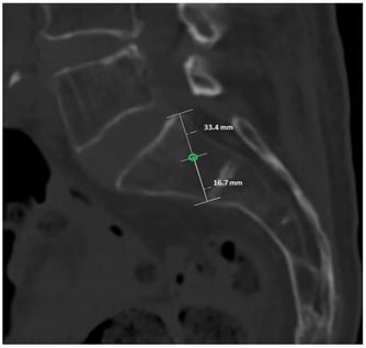 Lateral CT projection of the S1 vertebral body illustrating the standardized construction of the entry point. The dorsocranial and ventrocaudal cortical points are connected, and the midpoint of this line (green circle) represents the defined entry point (0 mm).