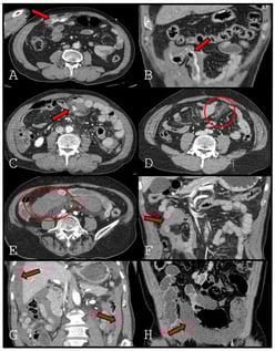 Representative CT findings in mesenteric injury after blunt trauma. (A). Extravasation type 1 (arrow). (B). Extravasation type 2 (arrow). (C). Pseudoaneurysm (arrow). (D). Mesenteric haziness (circle). (E). Mesenteric hematoma (circle). (F). Interloop fluid (arrow). (G). Dependent portion fluid (arrow). (H). Decreased bowel wall enhancement (arrow).