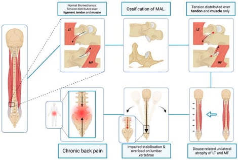 Schematic illustration of Domain 1 depicting the proposed muscular attachment mechanism by which ossification of the mamillo-accessory ligament (MAL) may influence segmental stability and contribute to genesis of chronic low back pain. LT = longissimus thoracis. MF = multifidus. (Figure was created by the authors using BioRender).