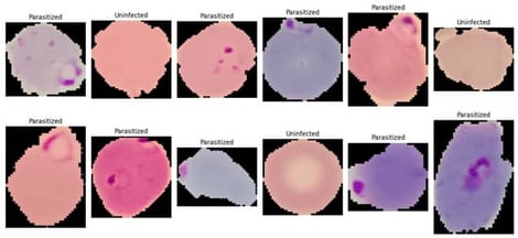 A single-cell image showing normal red blood cells (uninfected) and ring-form infected red blood cells (parasitized).