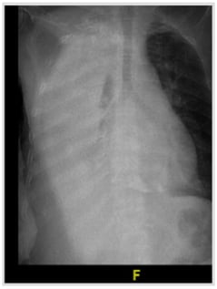 Routine chest x-ray showing significant right-sided pleural effusion with a blunting of right costophrenic angle, yet no obvious evidence of midline shift.