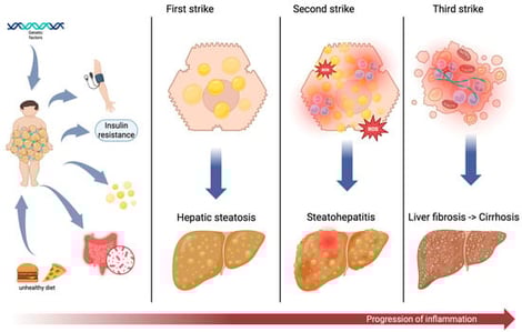 The “three-strike” hypothesis in the pathogenesis of MASLD in children. This figure illustrates the progressive pathophysiological model of MASLD, emphasizing its origins in childhood obesity. The left panel outlines key initiating factors, while in the right part is illustrated the three-strike model of MASLD progression. Created in BioRender. Podeanu, M. (2026) https://BioRender.com/zvnf4ku.