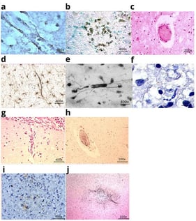 Microvessels in herpes infection and microvessels in infection caused by Haemophilus influenzae. (a) Herpes simplex virus antigen on the wall of a microvessel in a child who died of herpes encephalitis. IHC staining with Herpes simplex antibody; (b) Herpes simplex virus antigen on the wall of a microvessel and in the perivascular zone; (c) Mixed thrombus in the lumen of a microvessel. Infarction focus in the brain substance. H&amp;E staining; (d) Perivascular reaction of astrocytes in the brain of a child who died of herpetic encephalitis, IHC staining with GFAP; (e) Perivascular proliferation of astrocytes, detachment of astrocytic vascular pedicles in the white matter of the hemispheres. Impregnation according to the Cajal method; (f) Cytoplasmic lysis, dark neurocyte nuclei in the cerebral cortex. Nissl stain with toluidine blue, ×600; (g) Disruption of the structural integrity of the arteriolar wall in the cerebral cortex of a child who died from a hemophilic infection. H&amp;E staining; (h) Mixed thrombus in the lumen of a microvessel. Infarction in the white matter of the brain in a child who died from a hemophilic infection; (i) Expression of CD95 on the wall of microvessels in the cerebral cortex of a child who died from Haemophilus influenzae infection; (j) Expression of TNF on the wall of a microvessel and in the perivascular zone in a child who died from Haemophilus influenzae infection. The image was created based on the digital library on neuroinfection [30,31,32].