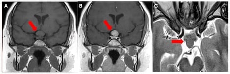 Coronal T1-weighted (A), T1-weighted after contrast (B) show a sellar and sovrasellar mass, involving the pituitary stalk and extending bilaterally in the parasellar region. Axial T2-weighted image (C) shows the low signal intensity of the lesion. The red arrows show the position of the mass.