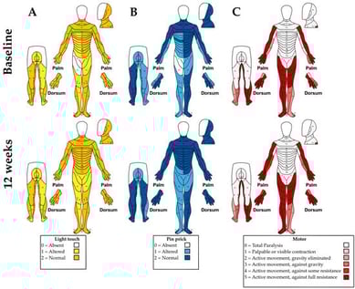 AIS evaluation at baseline (upper panels) and 12 weeks (lower panels). Sensory scores: (A) light touch and (B) pinprick; (C) motor scores.