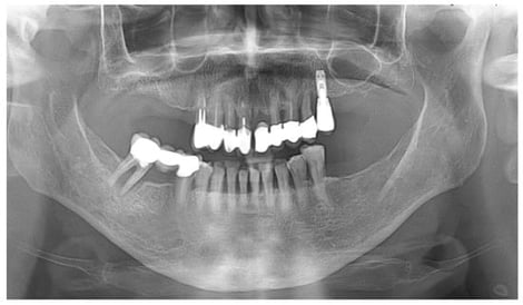 Preoperative panoramic radiograph. No radiographic signs of osteonecrosis were detected.