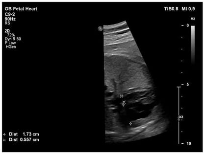 Four-chamber fetal echocardiographic view at 32 weeks’ gestation demonstrating measurement of the mitral valve annulus (0.557 cm) and tricuspid valve annulus (1.73 cm).