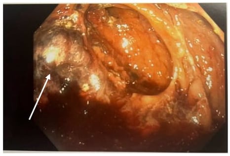 Photo from colonoscopy showing necrotic intestinal tissue (white arrow).