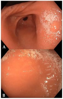 Endoscopic findings on upper gastrointestinal endoscopy. The mucosa appears endoscopically preserved in both antrum (A) and gastric body (B). This macroscopic normality is a hallmark of the initial phases of autoimmune gastritis, where the immune-mediated mucosal damage is only detectable at the microscopic level.