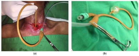 (a) Inflated Foley catheter placed at the site of greatest stenosis connected to the high-frequency jet ventilation catheter. To avoid barotrauma, Foley catheter balloon should be deflated after no longer than 2–4 min each time. (b) Foley balloon filled up using still water (10–15 mL) and placed in the area of greatest stenosis. The jet ventilator is attached to the Foley lumen, and low-volume, high-frequency air is passed through the Foley lumen into the lungs.