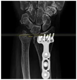 Measurement of ulnar variance.