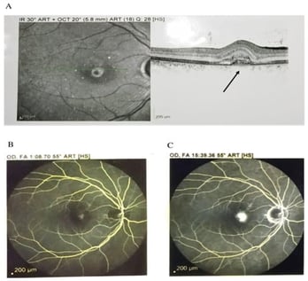 The OCT and fluorescein angiogram of the right eye of the studied subject. (A) OCT of the right eye at presentation showed fibrovascular pigment epithelial detachment with subretinal fluid and hyperreflective material nasal to fovea with outer retinal layer damage in the right eye (central retinal thickness, CRT 327 μm), black arrow indicates the CNV (B) The fluorescein angiogram showing early phase, an active lesion adjacent to fovea in the right eye. (C) Increase in size and intensity in the late phase indicative of active leakage.