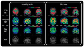 Multimodal neuroimaging features of healthy and AD brains. Representative FDG-PET, amyloid-PET, tau-PET, and sMRI images from the ADNI cohort. Compared with healthy controls, AD patients show reduced glucose metabolism, increased amyloid and tau deposition, and pronounced brain atrophy. Reproduced with permission from Ref. [18].