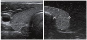 Combination image: (left)—human thyroid lobe as seen in ultrasound, (right)—thyroid phantom as seen in ultrasound with overlaid line measurements.