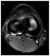(a) Axial proton density-weighted 1.5-T MRI image and (b) sagittal proton density-weighted 3-T MRI image demonstrating the popliteus hiatus (red asterisk) and the popliteus tendon (arrow) coursing through it.