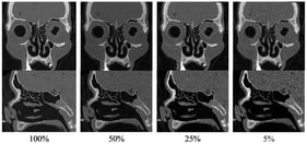 Representative coronal (top) and sagittal (bottom) PCCT images of the paranasal sinuses from a single body donor acquired at progressively reduced radiation dose levels (100%, 50%, 25%, and 5% of the reference dose, from left to right).