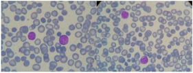Peripheral blood smear (100×). A relatively monomorphic lymphocytic population is observed without the presence of smudge cells (May–Grünwald Giemsa (MGG)).