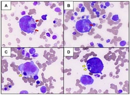 (A–D) Dysplastic megakaryocytes with emperipolesis (erythrocytes: red arrows; erythroblasts: yellow arrows) (May-Grünwald Giemsa Stain, 80× objective, Motic EasyScan Infinity 60).