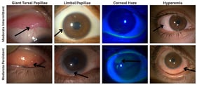 Representative clinical images demonstrating key ocular features in Moderate Intermittent and Moderate Persistent VKC. Moderate Intermittent VKC: Giant papillae are visible on the upper tarsal conjunctiva, accompanied by mild limbal papillae, localized corneal haze under fluorescein staining, and mild conjunctival hyperemia. Moderate Persistent VKC: More pronounced tarsal papillary hypertrophy is observed, along with prominent limbal thickening, extensive corneal epithelial damage and fluorescein uptake, and diffuse conjunctival hyperemia. Arrow are showing the clinical features written on top of of the respective figure.