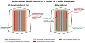 Schematic anterior view of the abdominal wall comparing complete (bilateral) transversus abdominis release (A) with partial TAR (pTAR) (B). In complete TAR, the transversus is divided along its whole cranio–caudal length bilaterally, with wide preperitoneal dissection. In pTAR the transversus and posterior layer are preserved except over the limited segment where midline tension persists; the transition zones between the released and the intact retromuscular plane are indicated. The retromuscular synthetic mesh is placed in the same plane in both techniques.