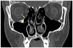 Coronal CT image showing right-sided HCs in an 18-year-old Iraqi male.