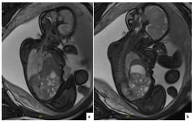 Fetal magnetic resonance imaging (MRI) at 31 weeks’ gestation. Coronal T2-weighted image (a) demonstrates marked elevation of the left hemidiaphragm with preserved diaphragmatic continuity. Axial T2-weighted image (b) shows intrathoracic displacement of the left hepatic lobe, spleen, and stomach, associated with compression of the left lung and preserved right lung volume and signal intensity.
